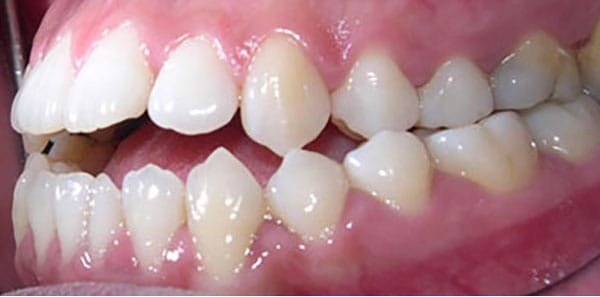 Before orthodontic treatment at Bhati Dental Clinic